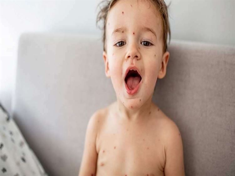 كل ما يجب أن تعرفيه عن العنقز عند الأطفال