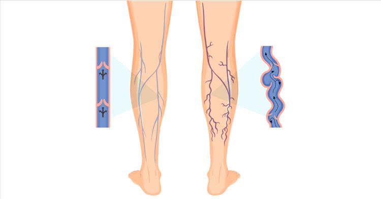 6 تمارين رياضية فعّالة لتخفيف أعراض الدوالي وتحسين صحة الساقين