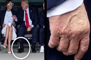كدمات غامضة وتشخيص بمرض مزمن يثير القلق حول صحة ترامب