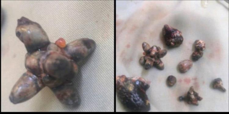 الدكتور ربيع الصبيحي ينجح في أستخراج حصوات من كلية مريض من ابناء ردفان في المستشفى الاردني