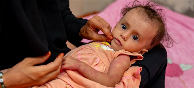 أطفال اليمن... سوء التغذية يعوّق نموّ الصغار وسط النزاع
