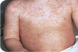 وفاة طفلة بعد رحلة بحث عن سرير عناية مركزة في مستشفيات المكلا