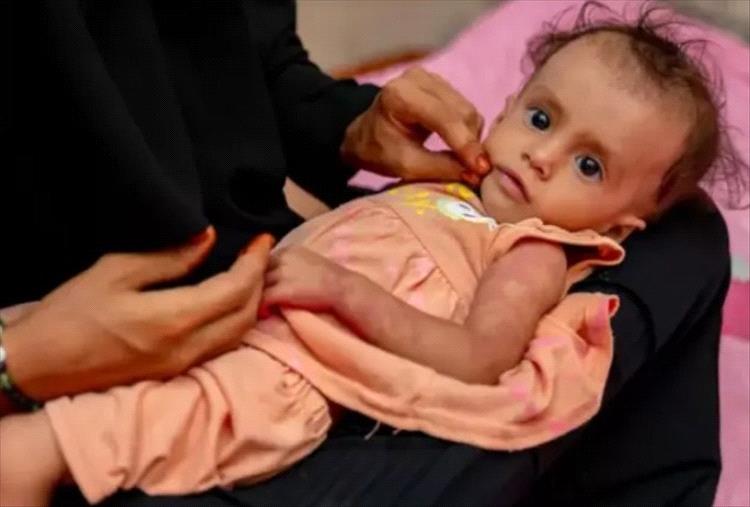 الصحة العالمية: اليمن واحدة من أسوأ أزمات الطوارئ في العالم