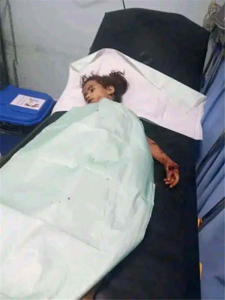فاجعة إنسانية تهز الضالع.. سقوط أطفال بين شهيد وجريح بانفجار جسم من مخلفات الحرب