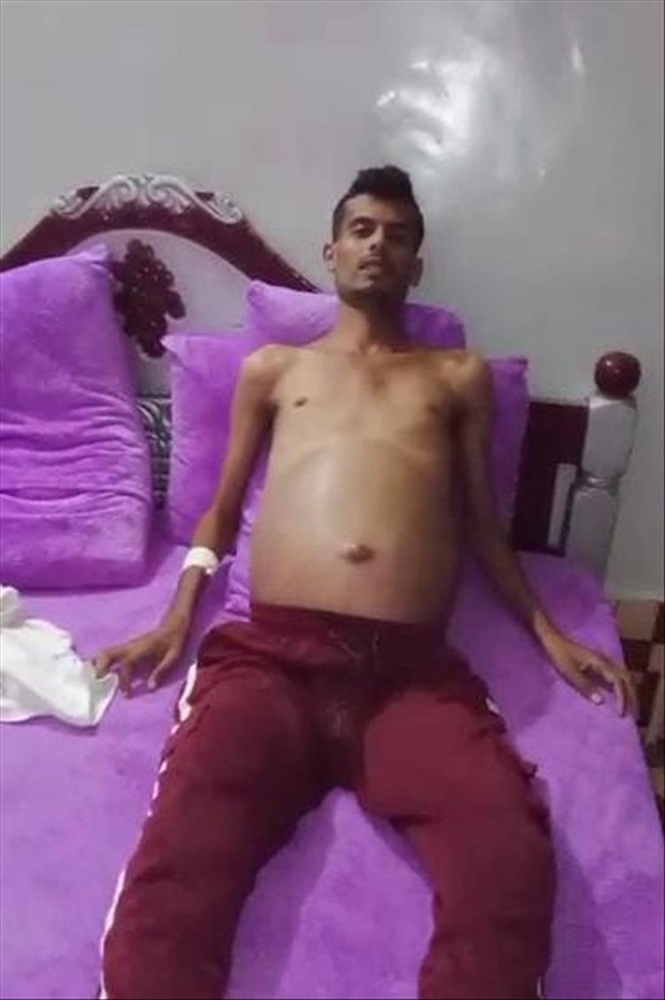 مناشدة إنسانية عاجلة .. مريض من أبين يحتاج دعمًا لإجراء عملية زراعة كبد خارج البلاد