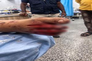 ألعاب نارية تتحول إلى خطر قاتل في عدن.. إصابة 4 أطفال وتحذيرات عاجلة للأهالي