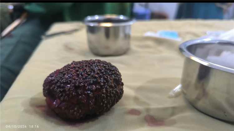 بوزن 300 جرام  الدكتور ربيع الصبيحي يستخرج حصوة عملاقة من مثانة مريض في المستوصف الأردني بعدن