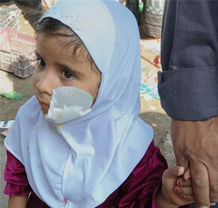 ثعالب مفترسة تواصل مهاجمة الأطفال والنساء في يافع وآخرها في حاجب الجعاون