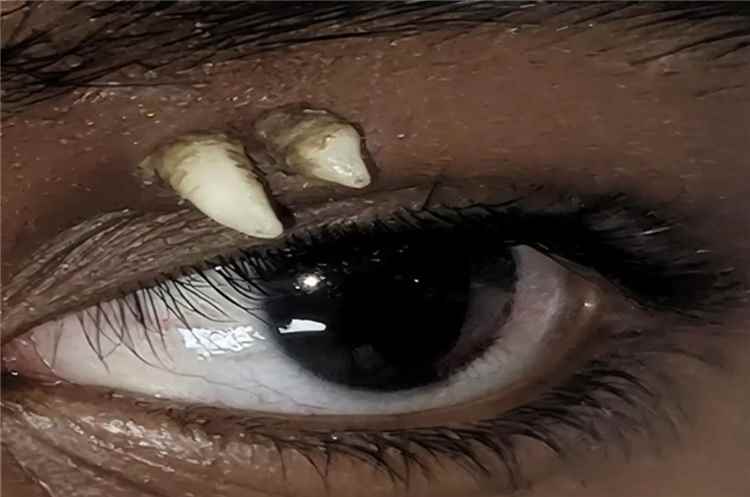 سن في مكان غير متوقع .. حالة نادرة تدهش الأطباء