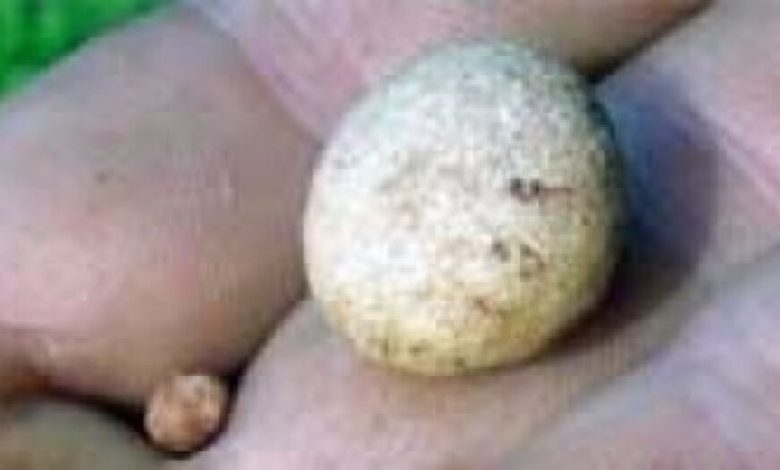 أسباب وأعراض الإصابة بحصوات الكلى