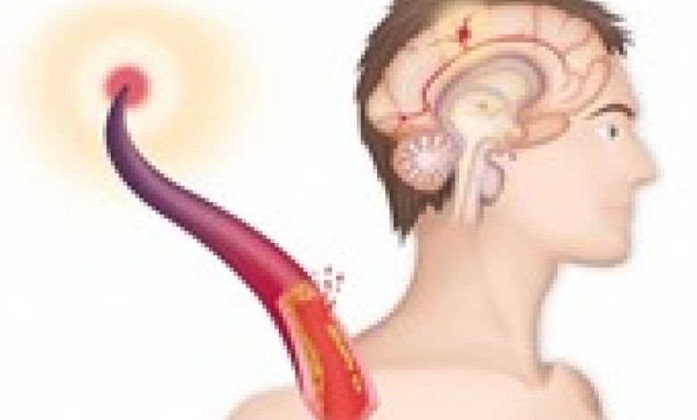 10 أعراض للسكتة الدماغية أبرزها الرؤية غير الواضحة والصداع الشديد