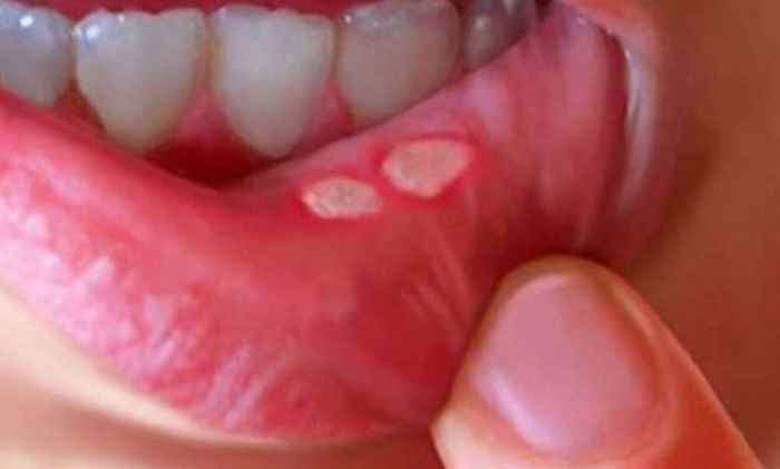 طريقة سحرية لعلاج قرح الفم خلال ساعات فقط